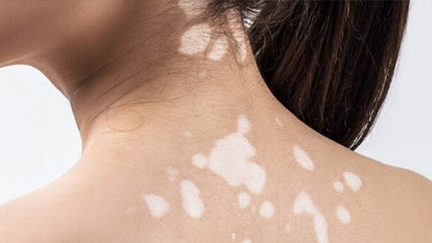 Đông y Bảo Thanh Đường: Khắc tinh của bệnh bạch biến